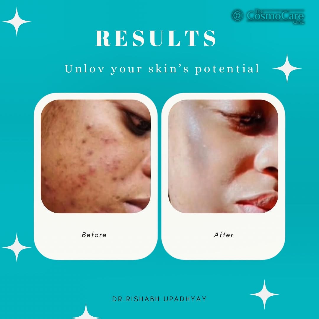 Doctor-supervised hair transplant results — CosmoCare Vapi