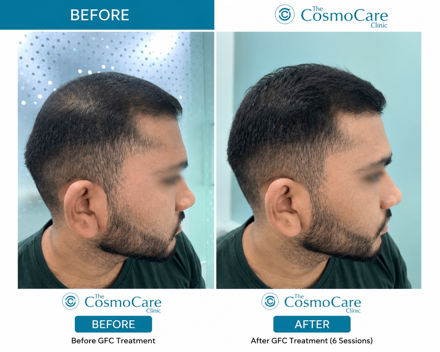 GFC hair-fall therapy before and after — 6 sessions at The CosmoCare Clinic, Vapi