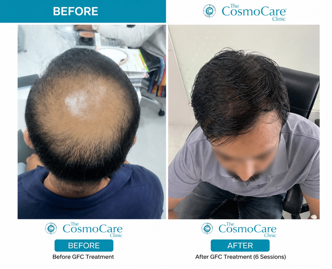 GFC hair-fall therapy before and after — 6 sessions at The CosmoCare Clinic, Vapi