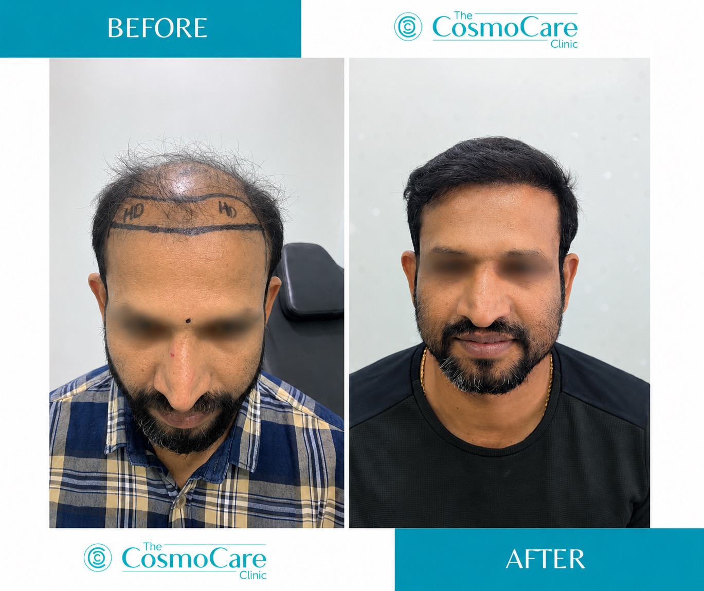 Hair transplant before and after result at The CosmoCare Clinic, Vapi