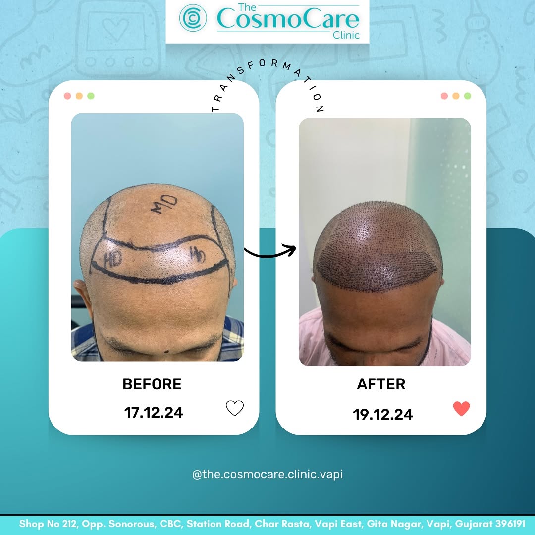 Hair transplant cost guide — CosmoCare Vapi
